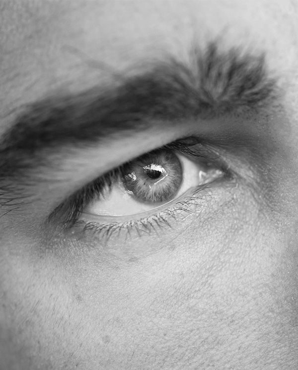 Homme • Injection • Toxine Botulique : Pattes d'oie